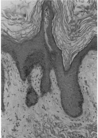 Slide 32 Acanthosis nigricans Velvety, hyperpigmented patches of skin after long-term exposure of the