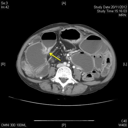 MRE-MRI