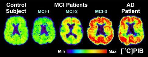 Απεικόνιση με PIB-PET Pittsburg compound-b (binds to amyloid