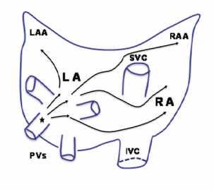 AF mechanisms Paroxysmal AF Trigger No Structural Heart Disease PV triggers