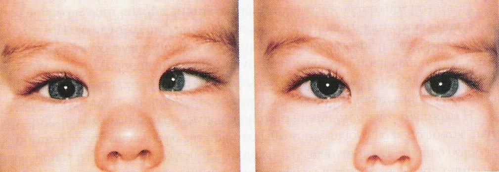 ΚΛΙΝΙΚΗ ΠΛΗΡΟΦΟΡΙΑ Διπλωπία: παράλυση οποιοδήποτε μυός Στραβισμός: Νευρομυική διαταραχή κατά την οποία τα δύο μάτια δεν κατευθύνονται ταυτόχρονα στο σημείο προσήλωσης.