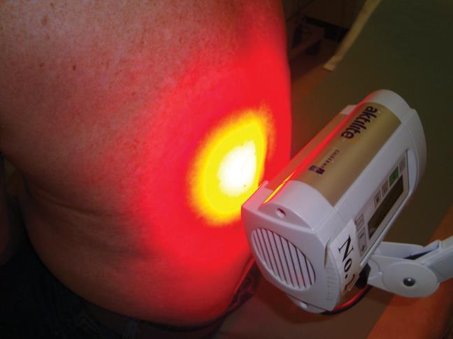 Θεραπείες off label PDT 20% 5-ALA thermal gel 100 J/cm² με 100-150 mw/cm² laser, 635 nm 3-10 συνεδρίες με 15d ενδιάμεσα