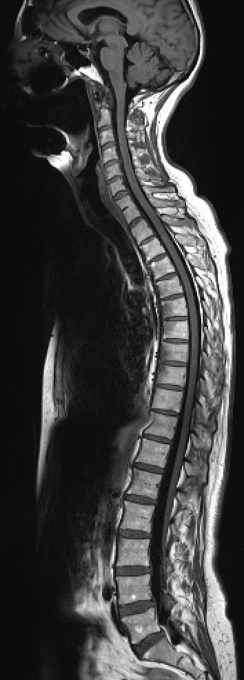 3 Tesla MRI STIR sequence