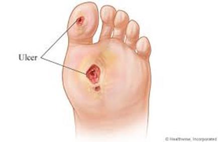 Active foot ulcer (Foot examination = Yes)