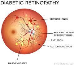 Retinopathy status (Retinal examination = Yes)