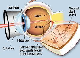 Laser Treatment on eye (Retinal examination = Yes) Laser Treatment Total