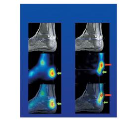 MOLECULAR IMAGING MRI 99mTc-HDP 111In WBC Gd