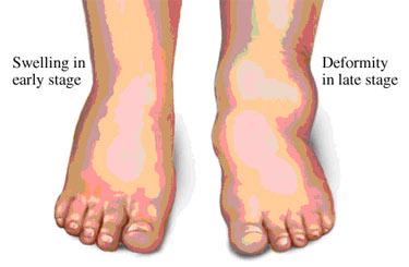 Διαβητικό Πόδι ü Νευροτροφική Οστεοαρθροπάθεια- ΝΟΑ (Charcot) 1% - 2,5%