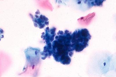 Organization Chart Title Atypical Glandular Cells ACG-NOS Risk of high grade lesion 10-40% ACGfavor neoplasia