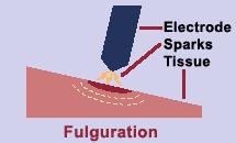 Δράση του μπλέ (coag) κουμπιού The electrode is in not contact A spark develops that causes the creation of a superficial char.
