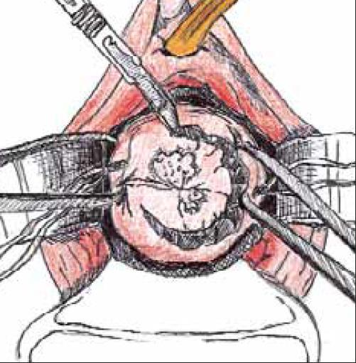 Κωνοειδής εκτομή - Τεχνική General Anaesthesia Cerclage