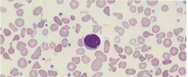 Μορφολογία Ερυθρών- είκτες Υποχρωµία Μακροκύτταρα Μικροκύτταρα Ποικιλοκυττάρωση Πολυχρωµατοφιλία