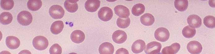 Μικροσκόπηση-Φυσιολογικό αίµα Ροζ κυτταρόπλασμα
