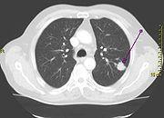 tumour in the left lung.