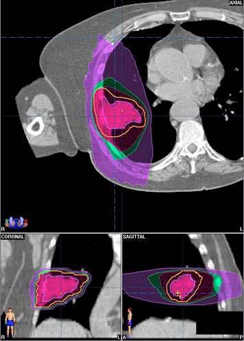 Radiotherapy 12: