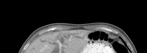Evidence of Bile Duct Obstruction: Dilated ducts upstream of the obstruction