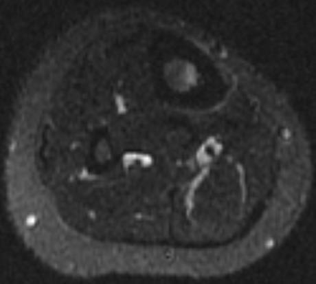 TIBIAL