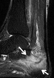 Radionuclide bone scanning is highly sensitive, but lacks specificity and the ability to