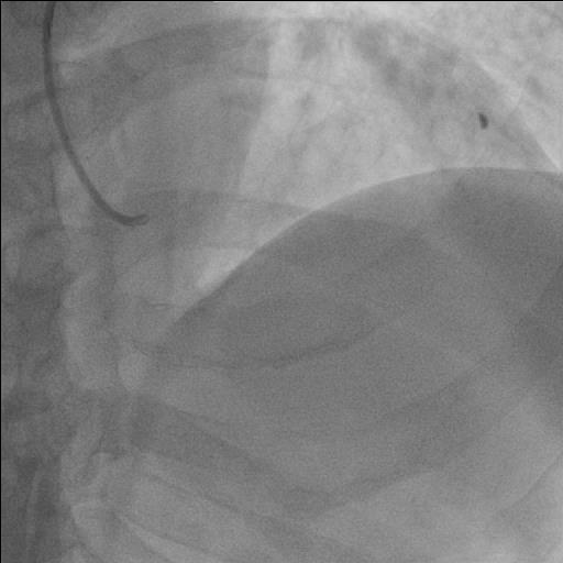 Pre PCI