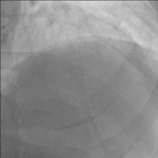 Pre PCI