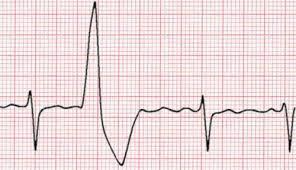 tachycardia/fibrillation, premature ventricular beats, and ICD interventions in different
