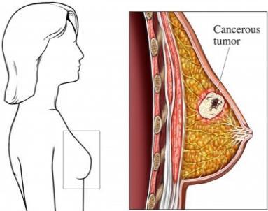 Precision Medicine Concept: Identify the