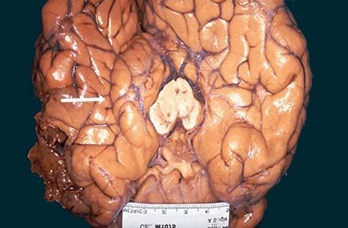 Κήλη αγκίστρου ιπποκάμπου οίδημα αριστερού εγκεφαλικού ημισφαιρίου μετατόπιση