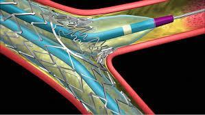 Stents για την αντιμετώπιση βλαβών διχασμού AXXESS