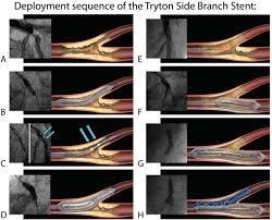 Stents για την αντιμετώπιση βλαβών διχασμού Tryton