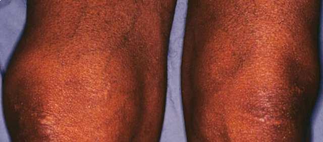 Gout.