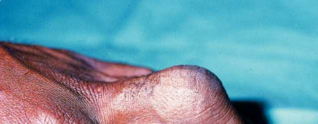 Gout. The finger is an