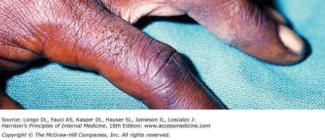 arthritis.