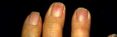 Inflamed