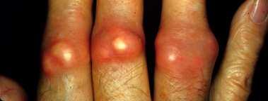 gout Courtesy