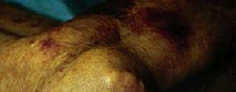 Tophus of