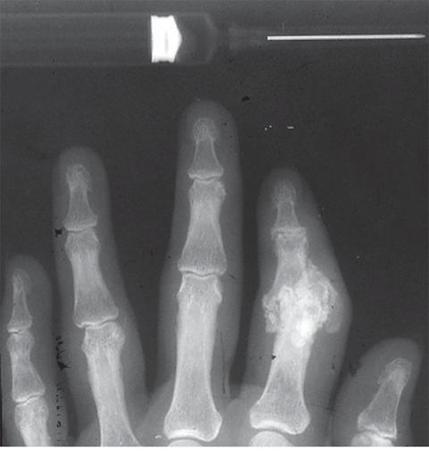 A. Radiograph showing calcification due to apatite