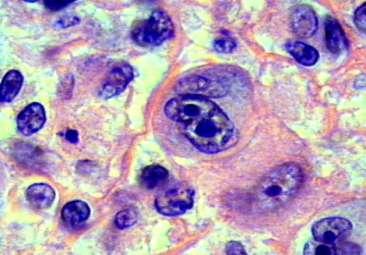 εισαγωγή Lymphoma is a type of cancer that originates in lymphocytes