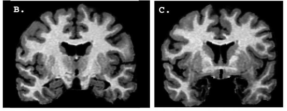 Klüver Bucy syndrome Urbach-Wiethe disease Σε πιθήκους Rhesus-Αφαίρεση Αμυγδαλής ΕΛΛΕΙΨΗ ΑΝΤΙΔΡΑΣΗΣ ΦΟΒΟΥ ΒΡΩΣΗ ΑΚΑΤΑΛΛΗΛΩΝ ΤΡΟΦΩΝ ΑΥΞΗΜΕΝΗ