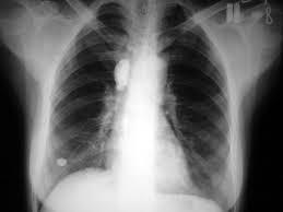 Πρωτογενής φυματίωση Συχνά ασυμπτωματική Πυρετός, θωρακικό άλγος, εύκολη