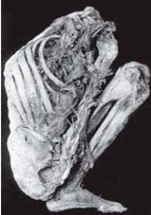 Φυματίωση-Ιστορική αναδρομή (Ι) Αποδεικτικά στοιχεία για παρουσία της νόσου από την Προϊστορική εποχή (8000 π.χ.) Αρχαία Αίγυπτος: Χαρακτηριστικές αλλοιώσεις ΣΣ σε Αιγυπτιακές μούμιες (1000 π.