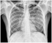 Κεγχροειδής φυματίωση Πρωτογενής λοίμωξη: οξεία, κεραυνοβόλος Αναζωπύρωση: υποξεία/χρόνια Παθογένεση: Αιματογενής διασπορά