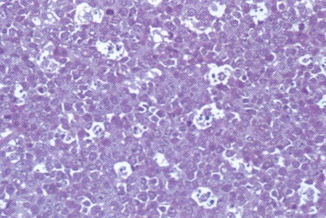 LYMPHOMA)