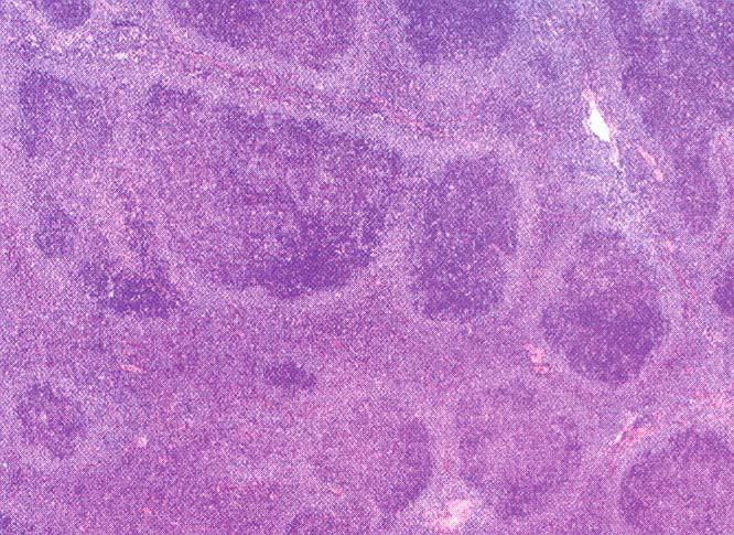 ΟΖΩΔΕΣ ΛΕΜΦΩΜΑ (FOLLICULAR CENTER LYMPHOMA) Προσβάλλει