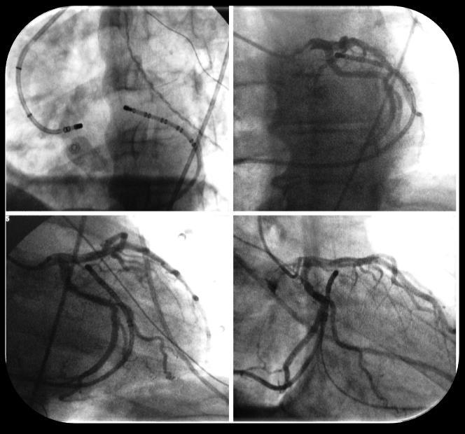 Left ventricular