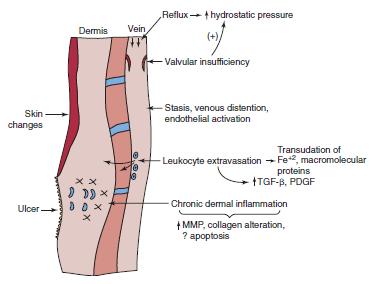 Εικ. 13: Η παθογένεια της χρόνιας φλεβικής ανεπάρκειας. Η φλεβική υπέρταση προκαλεί φλεγμονώδη αντίδραση. FE+2, Ferrous iron; PDGF, platelet-derived growth factor; TGF-β, transforming growth factor-β.