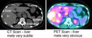 Το PET SCAN είναι μία απεικονιστική εξέταση που δείχνει αν υπάρχουν καρκινικές μεταστάσεις.