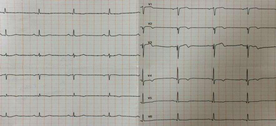 Άνδρας 55 ετών Βαρύς καπνιστής, Οικογενειακό ιστορικό Οπισθοστερνικό άλγος διάρκειας ½ ώρας, πριν από 1 ώρα, τώρα