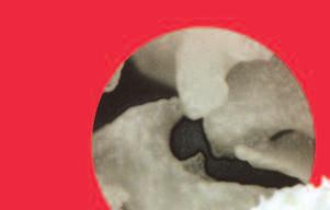 Allograft for bone void filling