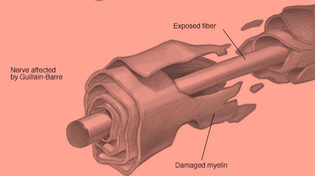 Σύνδρομο Guillain-Barre Gardasil 9 VAERS (ΗΠΑ) Δεκ 2014- Δεκ 2017