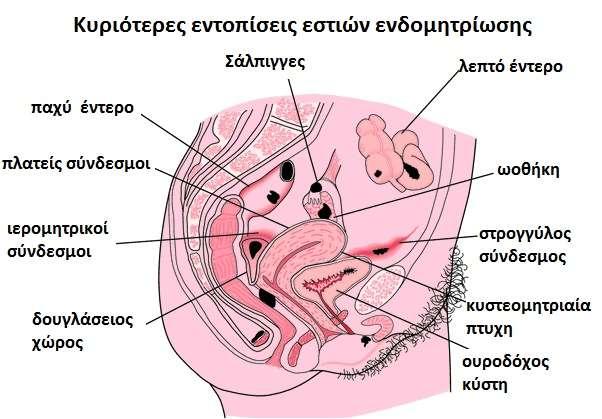 έχουν ιστορικό ενδομητρίωσης.